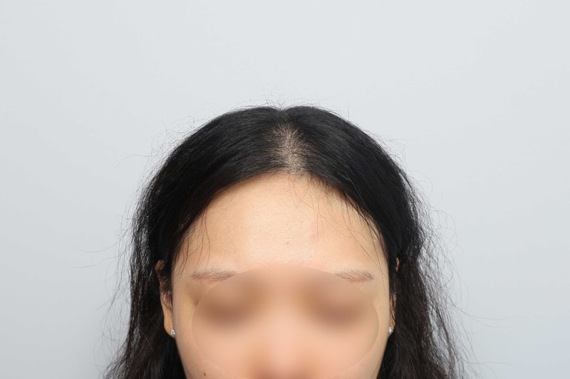  여자 정수리 전두부 무삭발비절개 1500모낭 7개월 모원성형외과
