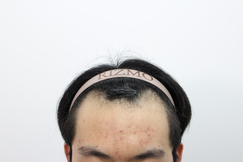 부산 리즈모의원 모발이식 8개월 경과