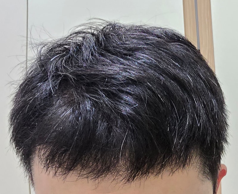 모발이식후 6개월
