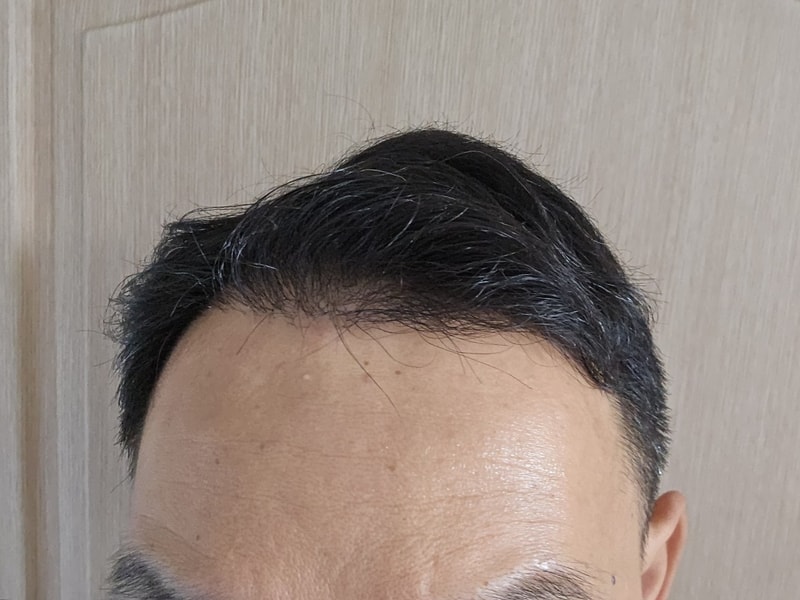 4. 수술후_6개월_셀카_1.jpg