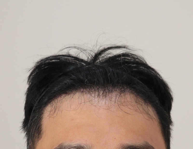 3. 수술후_6개월_1.JPG