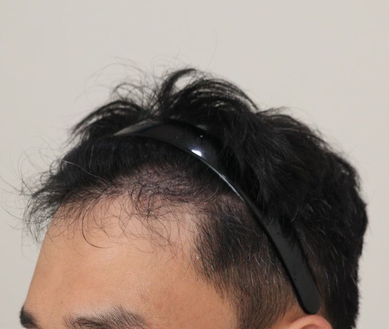 3. 수술후_6개월_3.JPG