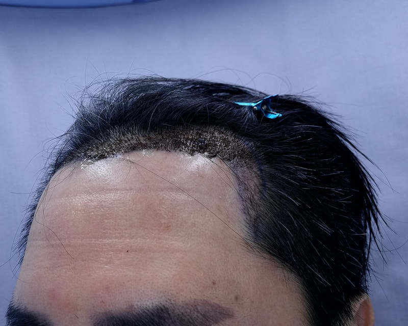 2. 수술후_1일_3.jpg