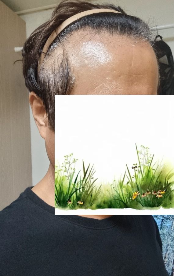 (다나성형외과 비절개모발이식 두달)50대 새출발 성공적이네요
