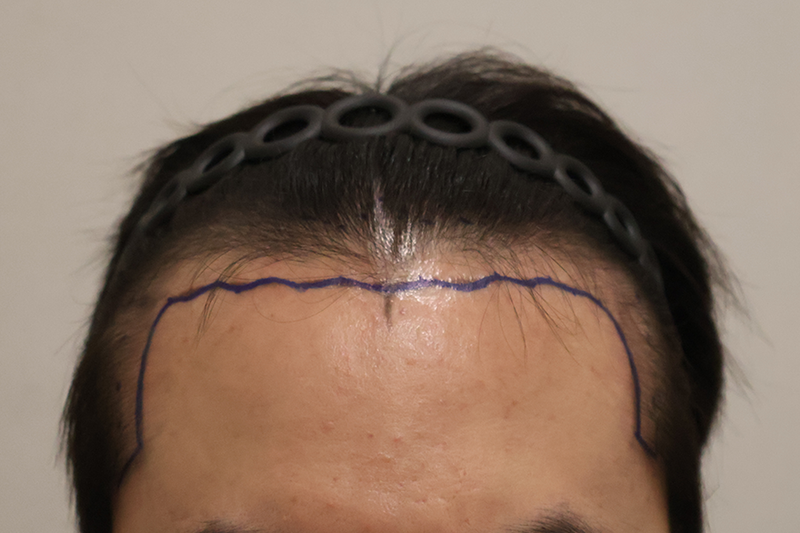 HAIRO HAIR TRANSPLANT CENTER Dongtan 3600 Mo Hair Transplant is here for the 9th month review ^^