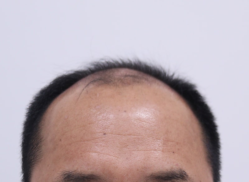 1. 수술전_1.JPG