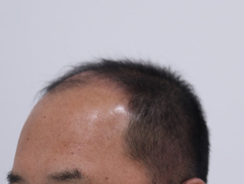 1. 수술전_2.JPG