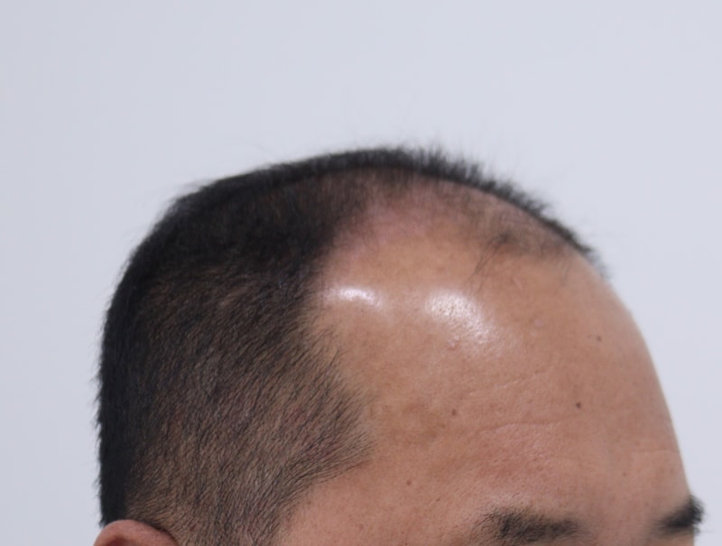 1. 수술전_3.JPG