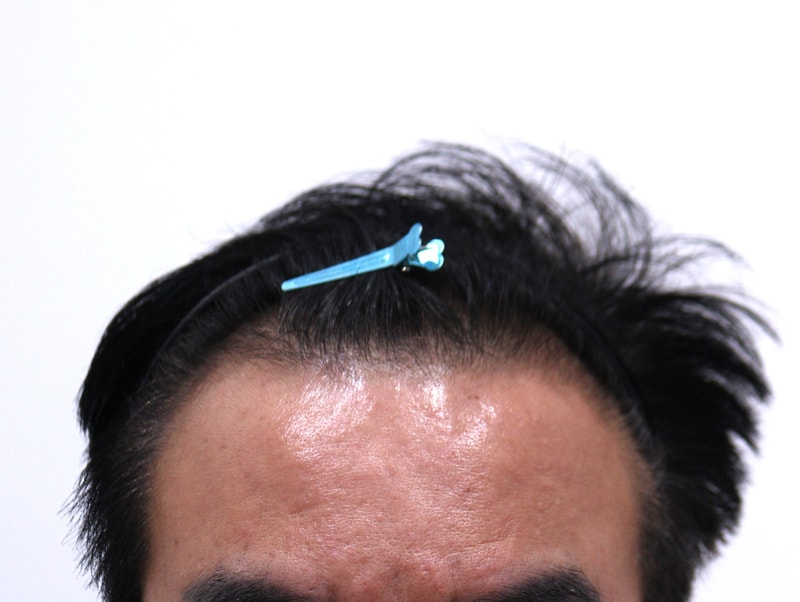 1. 수술전_1.JPG