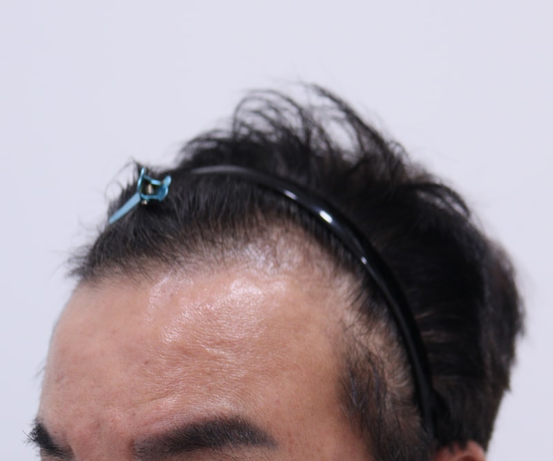 1. 수술전_3.JPG