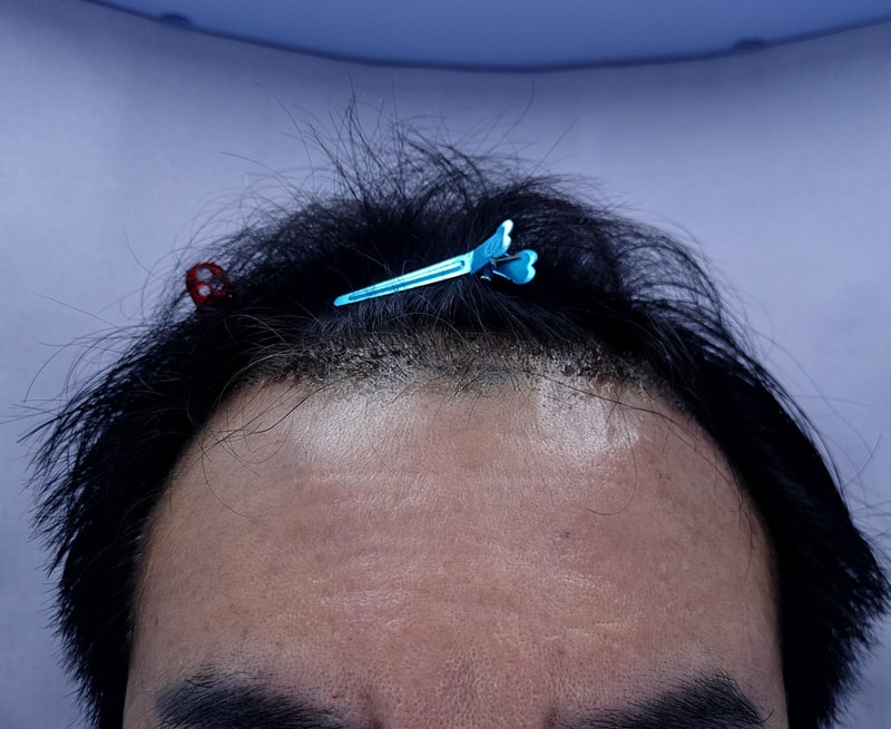 2. 수술후_1일_1.jpg