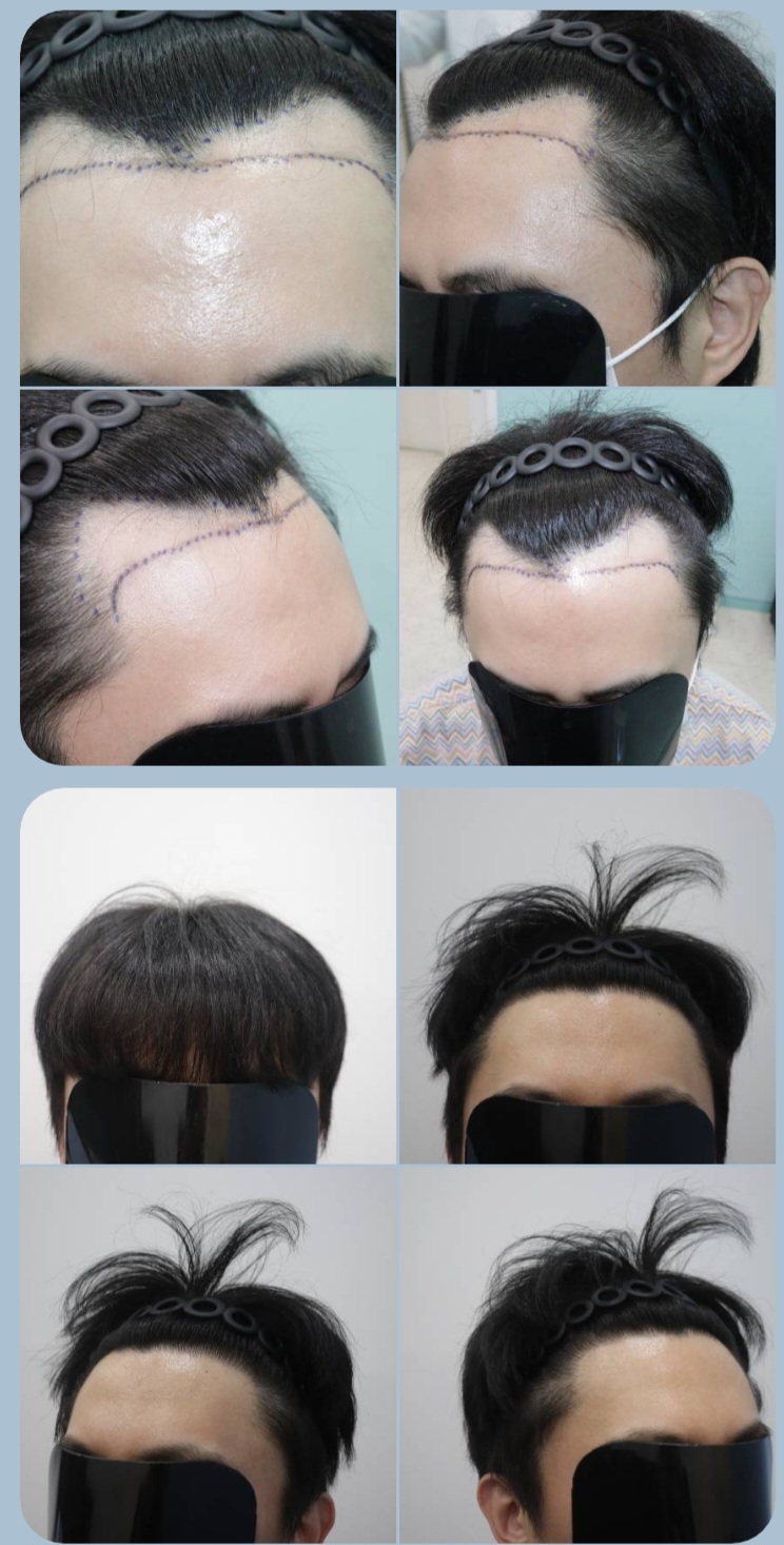 광주압구정모비앙 비절개 무삭발 10개월 후기