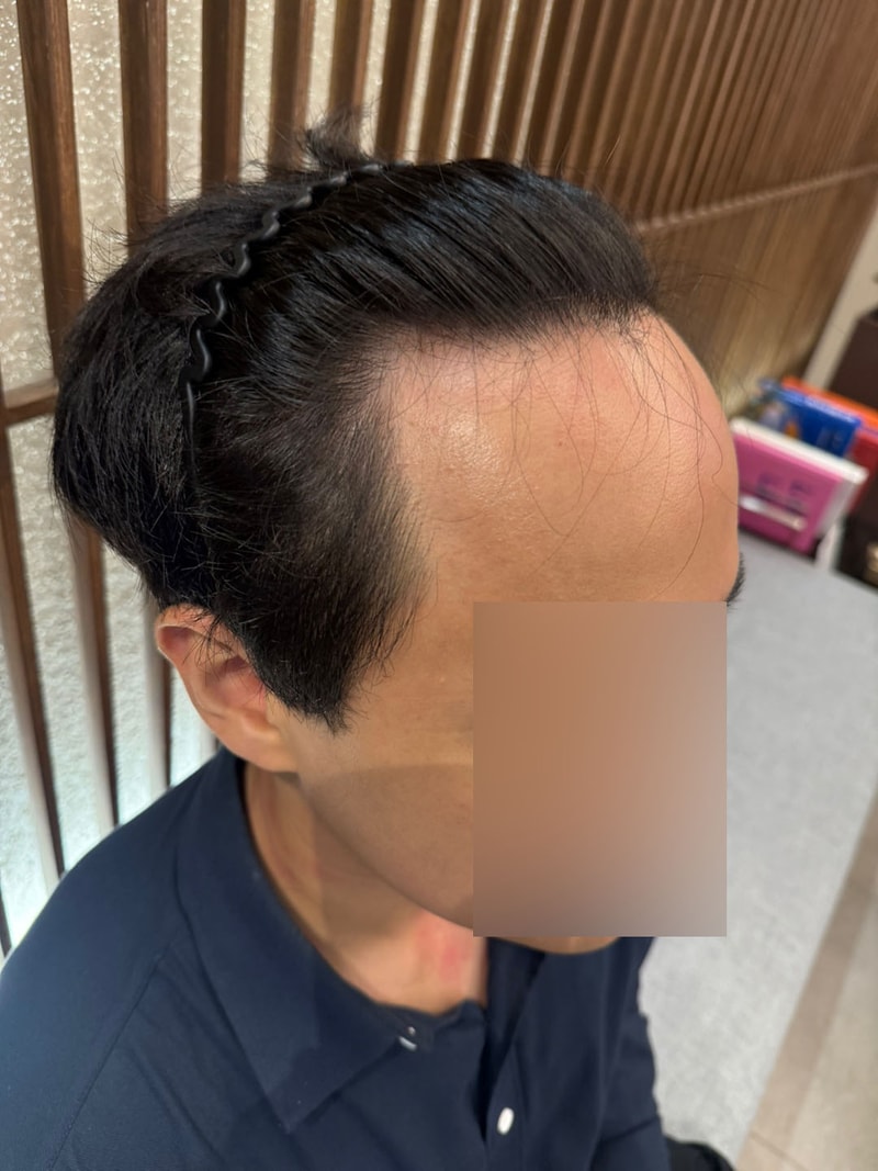 Shinsa Mowon Plastic Surgery 2500 Hair Orthopedic Non-Cutting Hair Transplant 7 Months