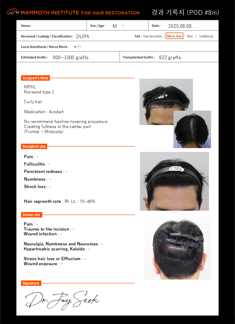【江南区マンモスヘアラインクリニックヘアラインウィン植毛 8か月体験談】