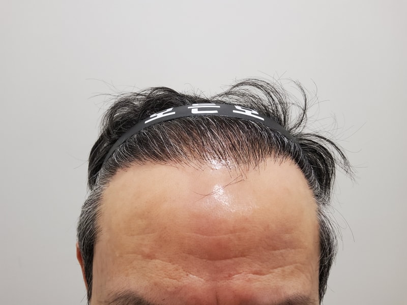 4. 수술후_1년_1.jpg