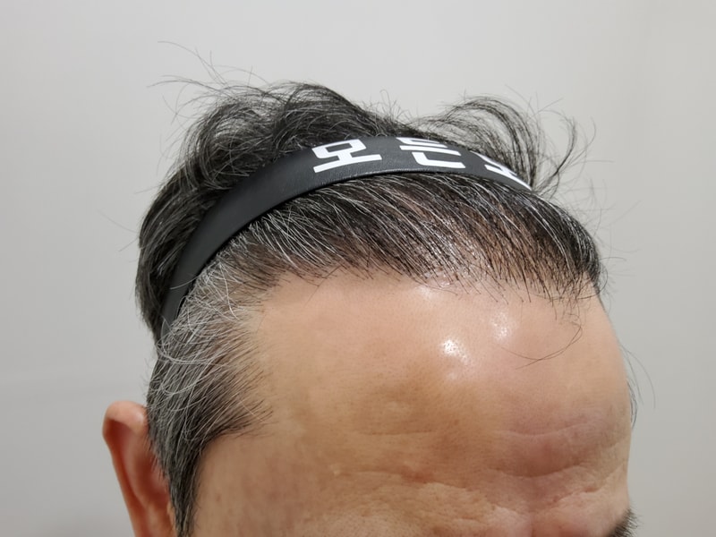 4. 수술후_1년_2.jpg