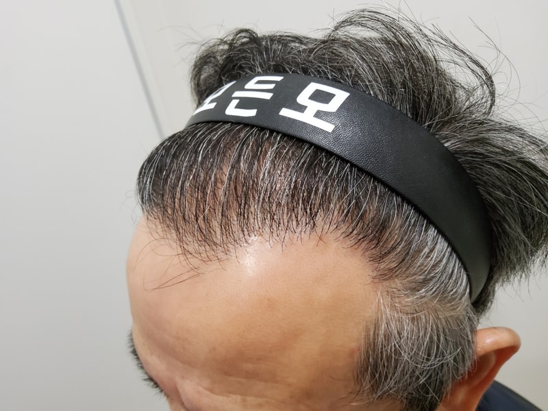 4. 수술후_1년_3.jpg