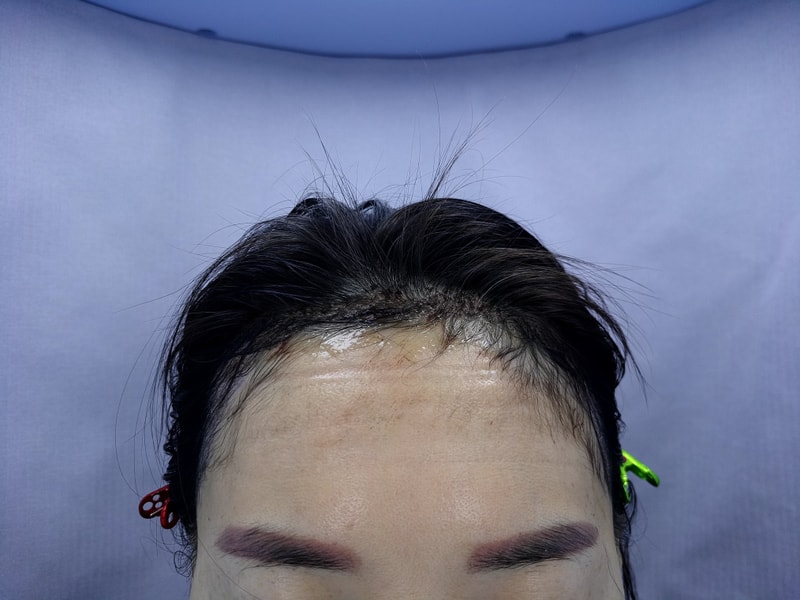 2. 수술후_1일_1.jpg