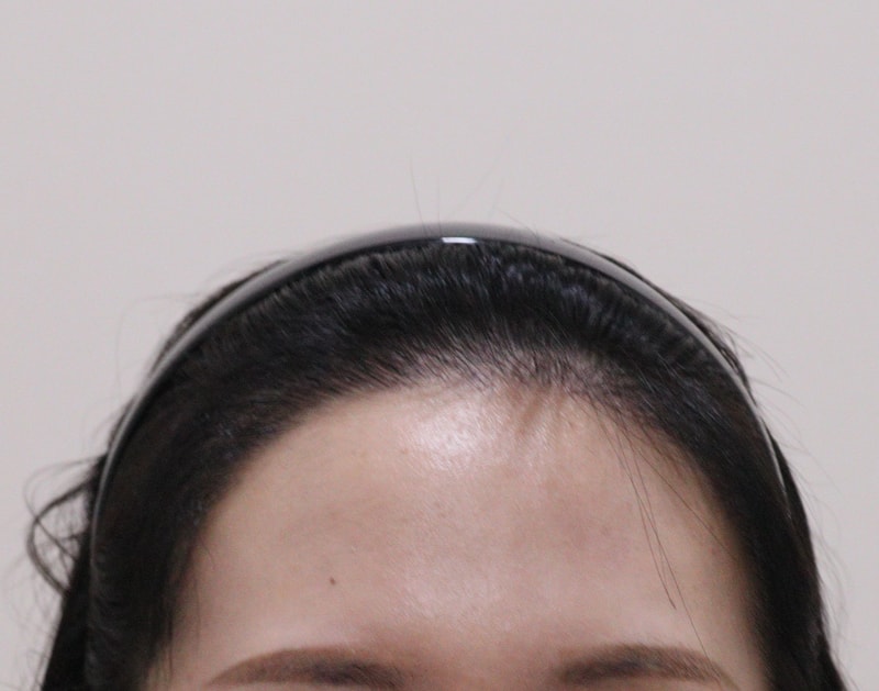 3. 수술후_6개월_1.JPG