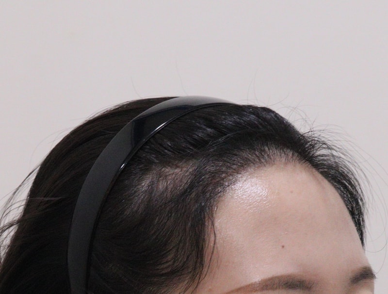3. 수술후_6개월_4.JPG