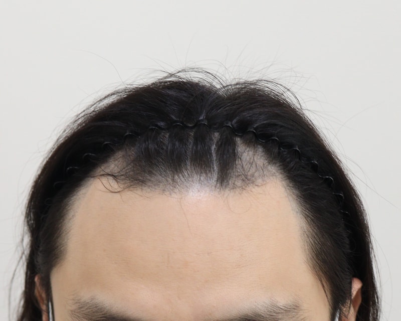 1. 수술전_1.JPG