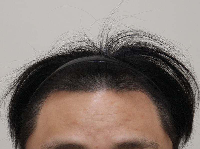 3. 수술후_6개월_1.JPG