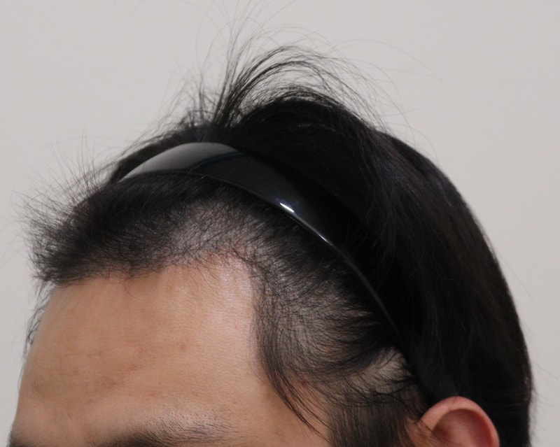 3. 수술후_6개월_2.JPG