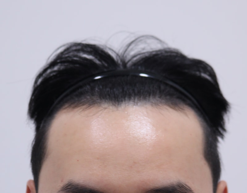 1. 수술전_1.JPG