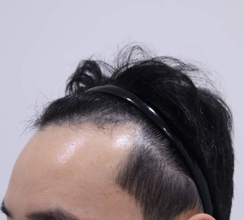 1. 수술전_3.JPG