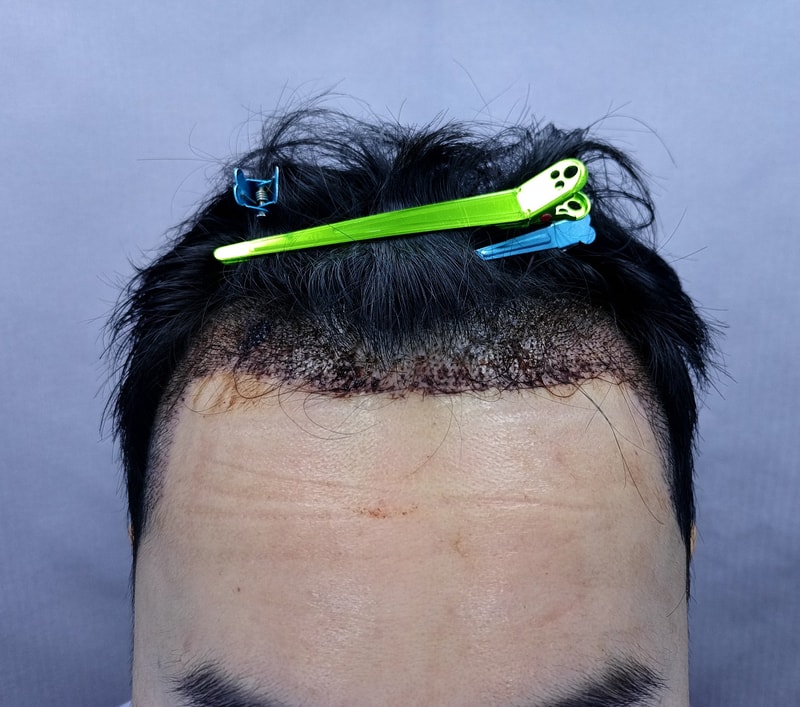 2. 수술후_1일_1.jpg