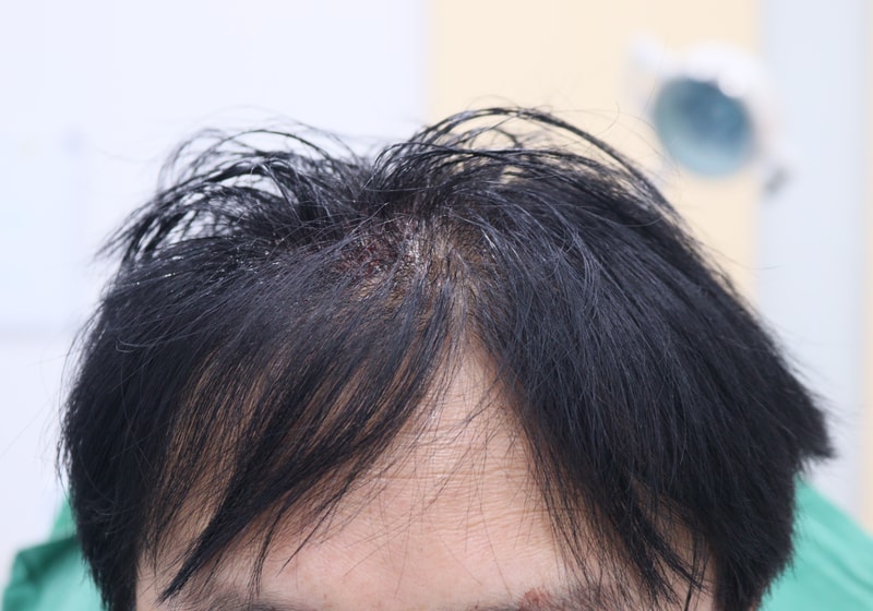 2. 수술후_당일_1.JPG