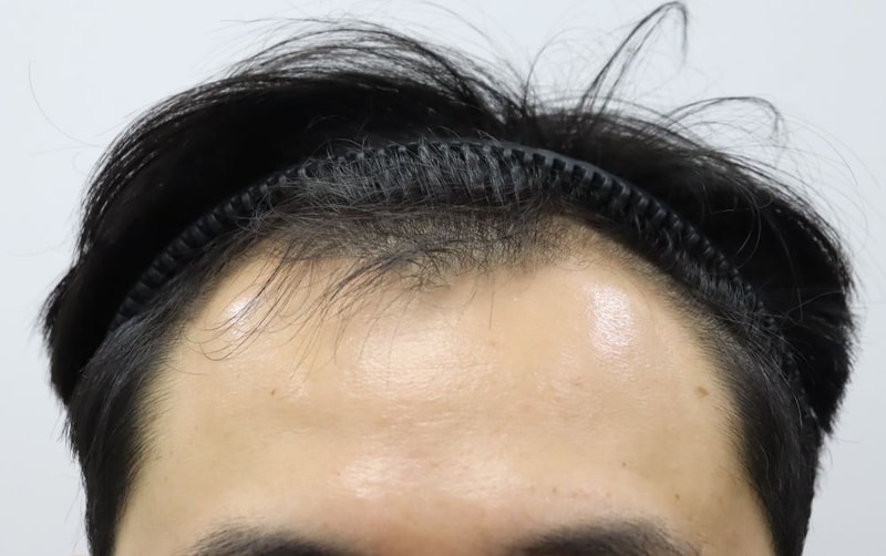 압구정 포헤어의원 깊은 M자탈모 비절개슬릿 모발이식 2달차 암흑기 진행중 후기 