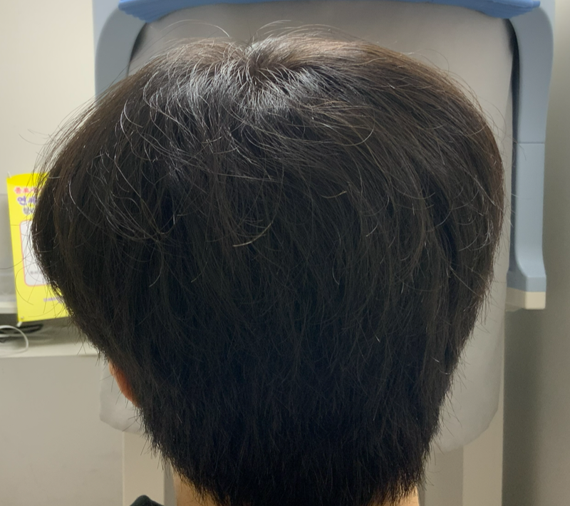 김현진94 일주일경과 뒷머리.PNG