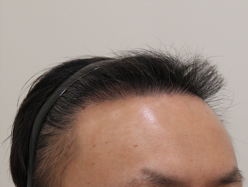4. 수술후_6개월_2.JPG