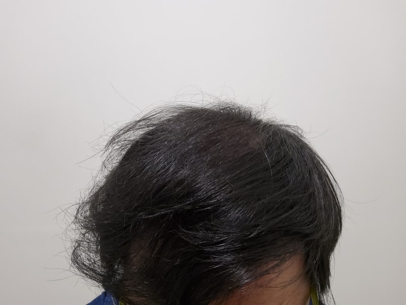 4. 수술후_1년_2.jpg
