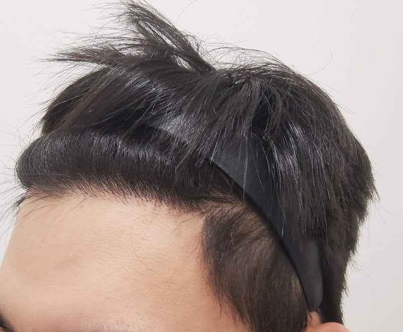 4. 수술후_1년_2.jpg