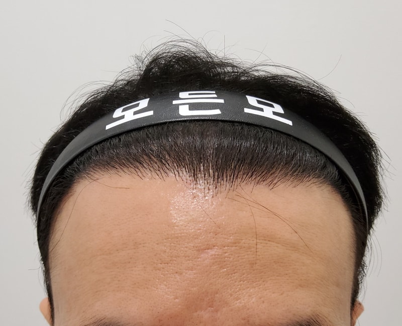5. 수술후_1년_1.jpg