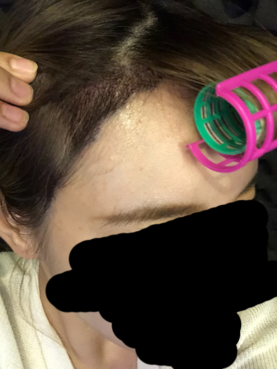 2. 수술하고 2일차 됐을 때 찍어뒀던 사진.jpg