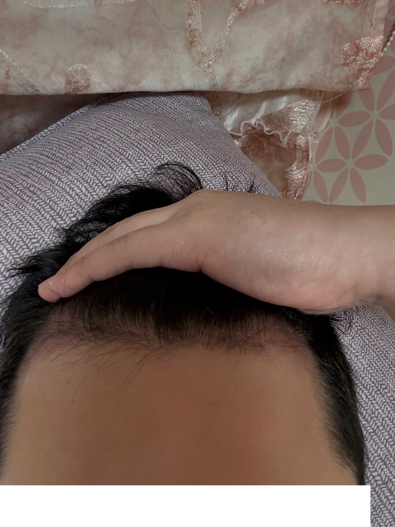 Back-to-school student's no-cut incision on day 60 (Sinsa Station Dana Plastic Surgery)