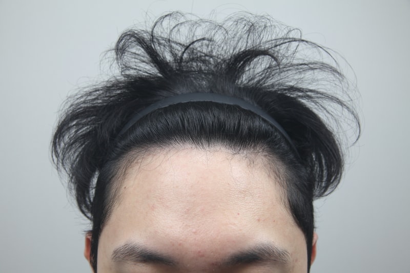모나라 피부과에서 모발이식 수술 받았습니다!!