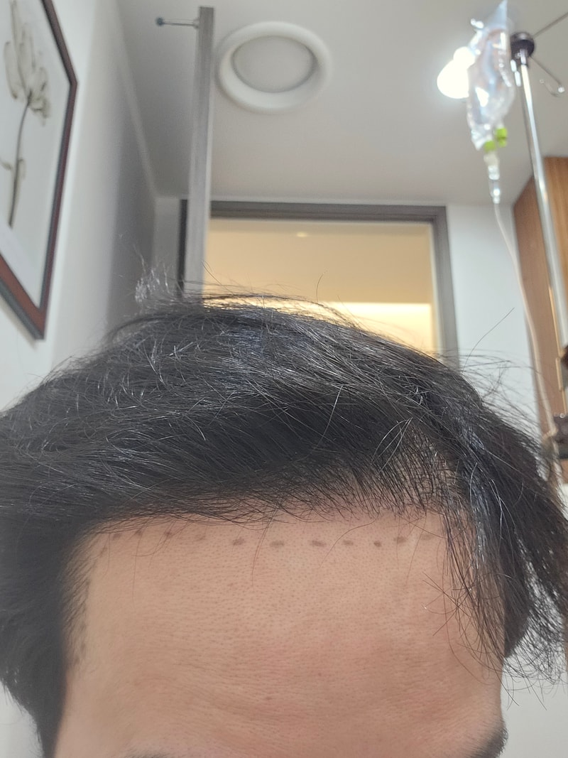 모재성성형외과 비절개 M자 및 헤어라인 1일차 후기