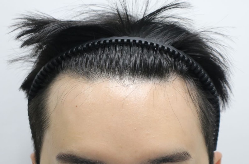 Non-intersected hair transplant of a bride-to-be who is about to get married, the 4th-month review of Apgujeong Four Hair (Director Kwon Oh-sung)