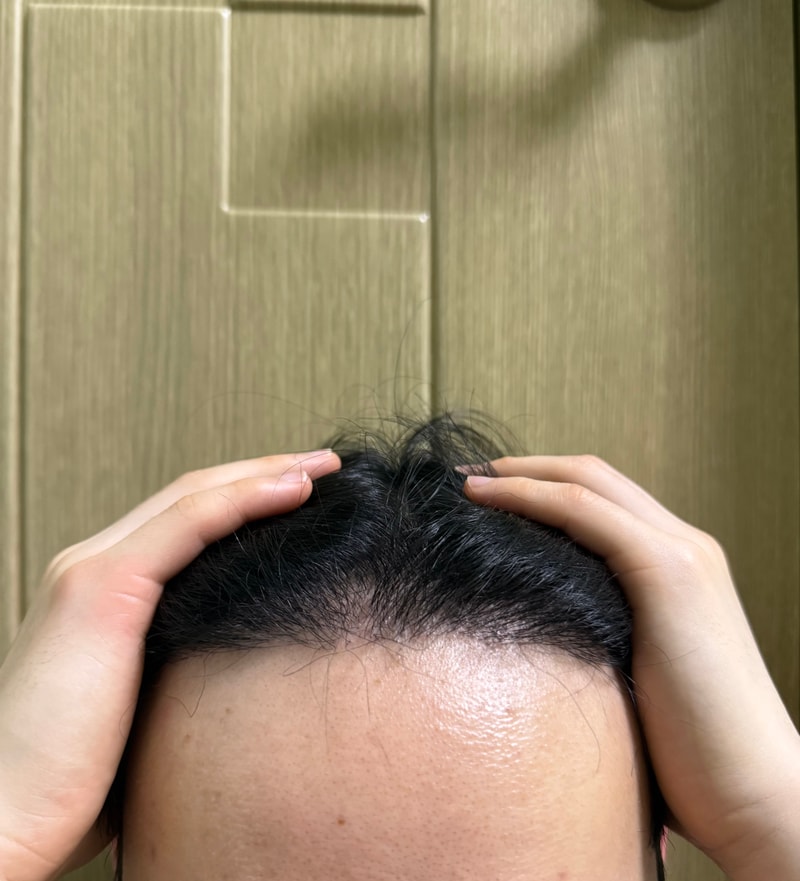 ニューヘアー6か月目の非切開植毛 体験談 / 1500株