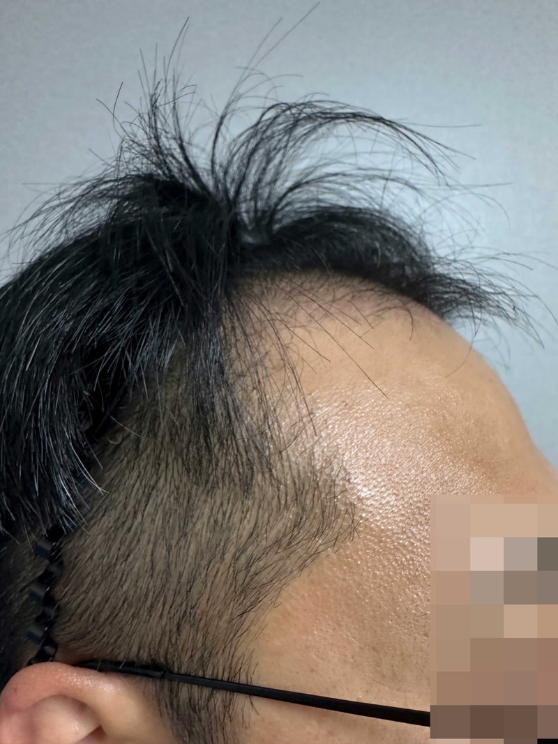 無髪・非切開をおすすめする理由は、内側から湧き上がる本当の自信があるからです！DANA整形外科4600本、4か月間使用しました