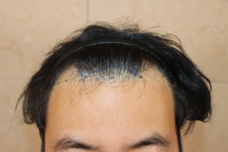 수술후기