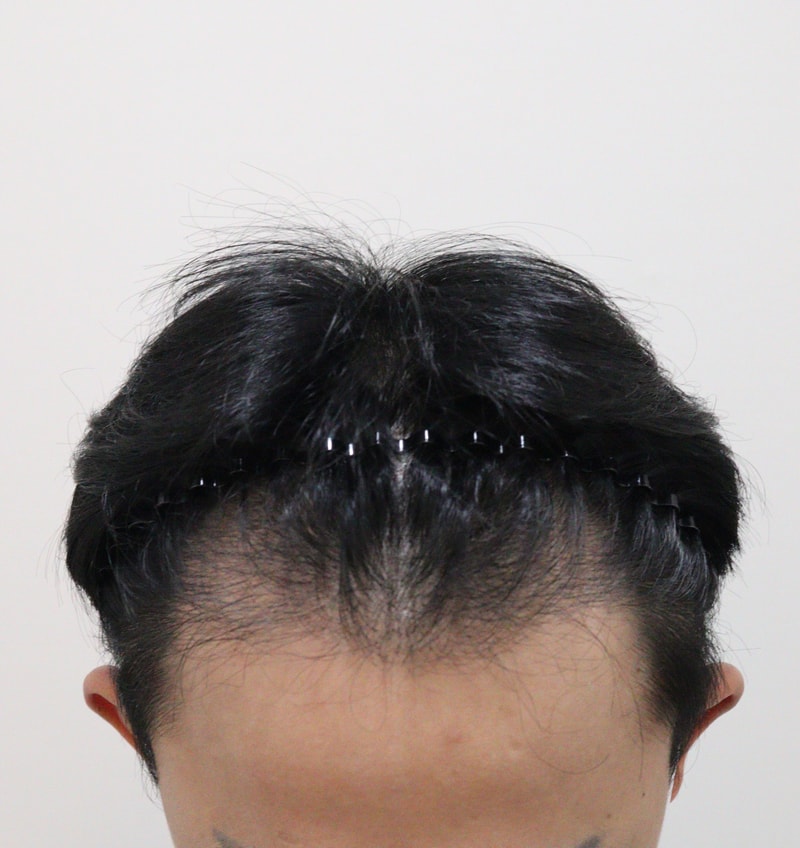 0. 수술전_2.JPG