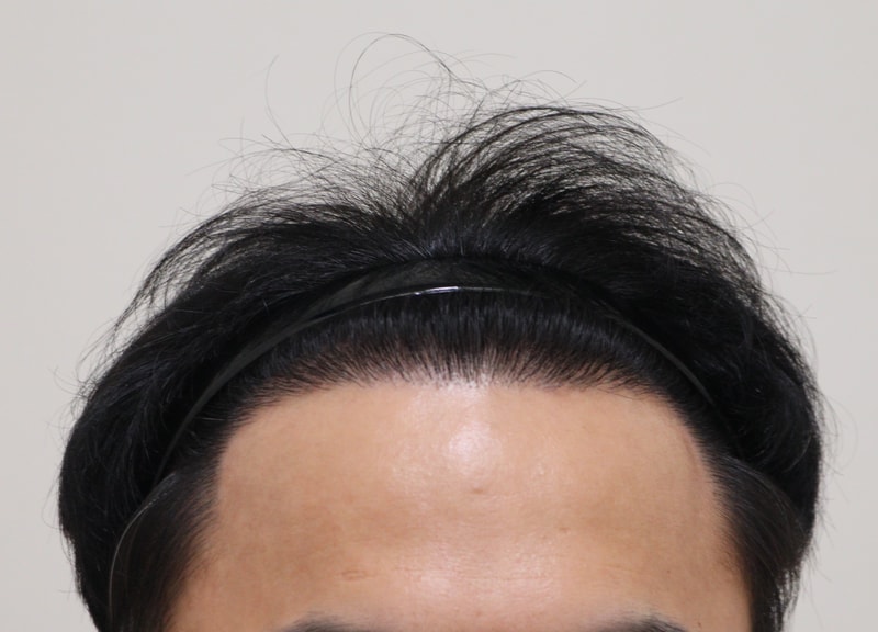 4. 수술후_1년_1.JPG