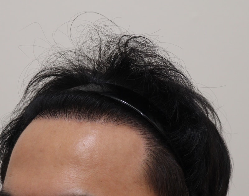 4. 수술후_1년_3.JPG
