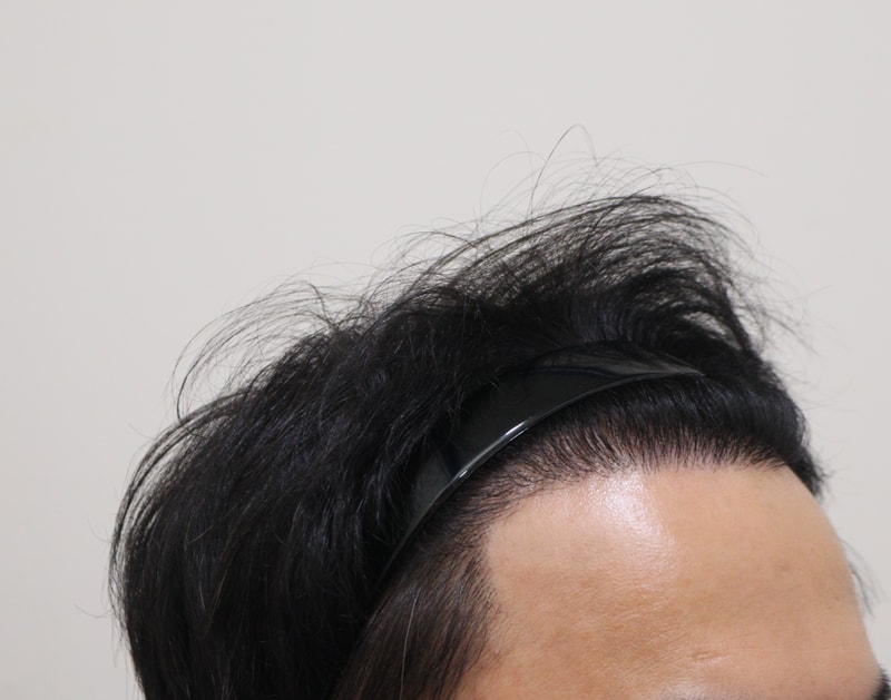 4. 수술후_1년_4.JPG