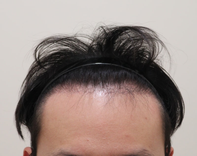3. 수술후_6개월_1.JPG